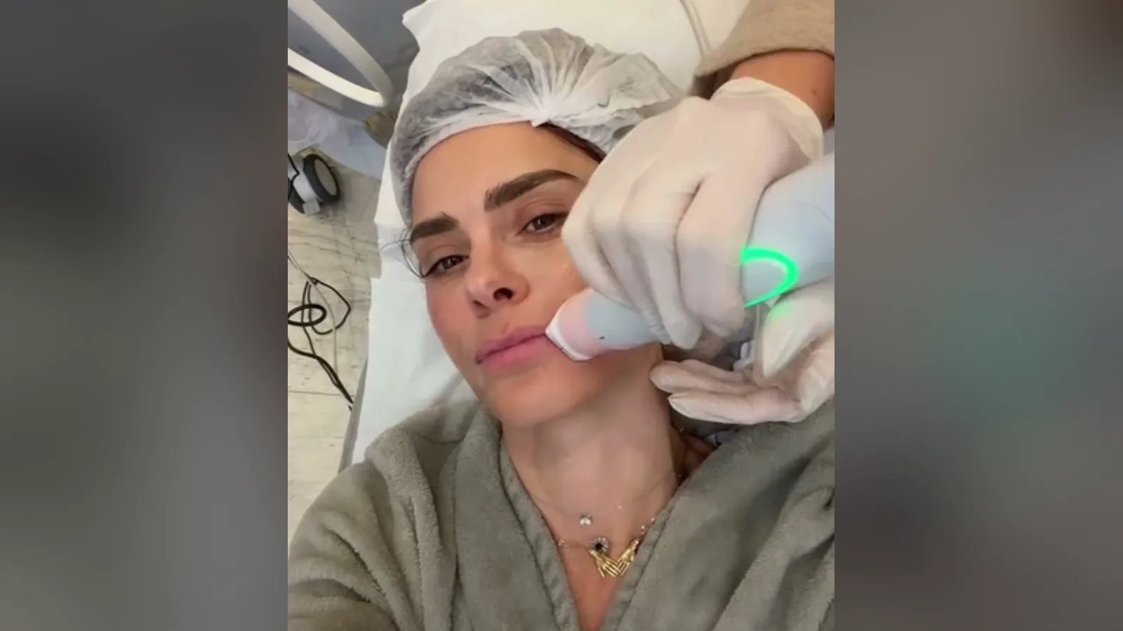 Ponteira do aparelho de radiofrequência encostada no rosto de Carolina Dieckmann, aplicada por mão com luva